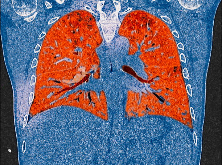 A CT scan of lungs showing the affects of Covid-19.